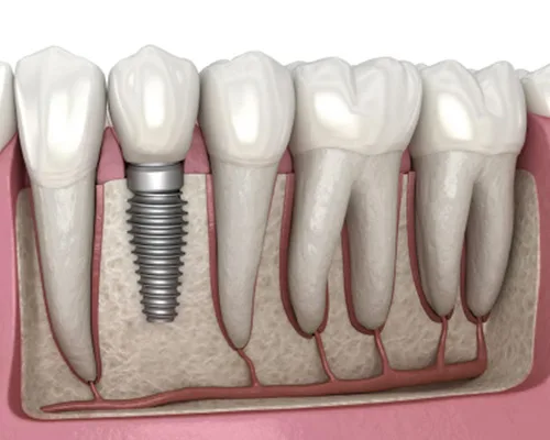 Dental Implants in Seegehalli