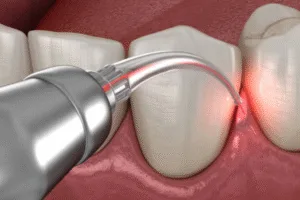 Gingival Depigmentation