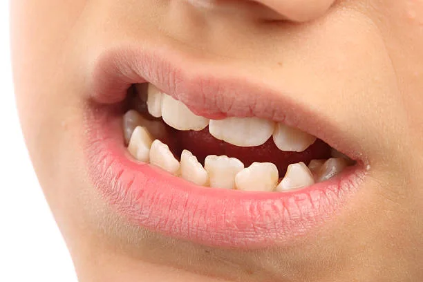 When Should You Start Jaw Development Treatment?