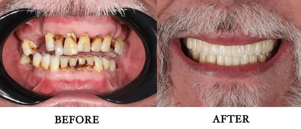 Full Mouth Rehabilitation in Seegehalli