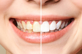 Teeth Whitening in Seegehalli