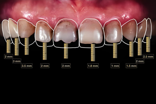 Digital Smile Designing