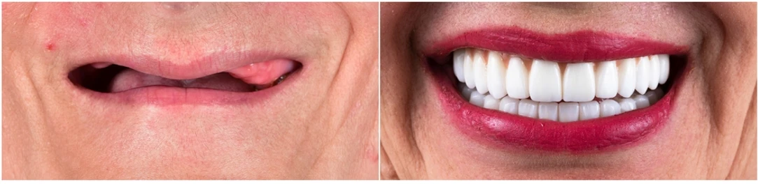 cost of Full Mouth Rehabilitation in Seegehalli