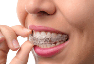 Aligners Treatment in Seegehalli