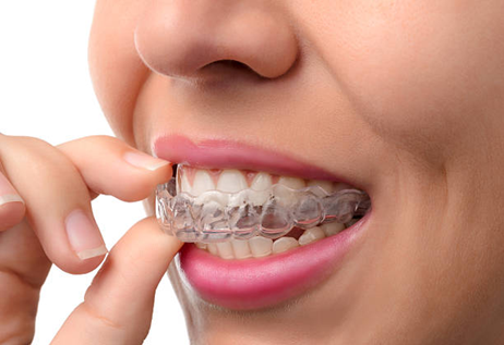 Aligners Treatment in Seegehalli