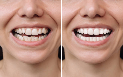 Who is the Right Candidate for Aligners