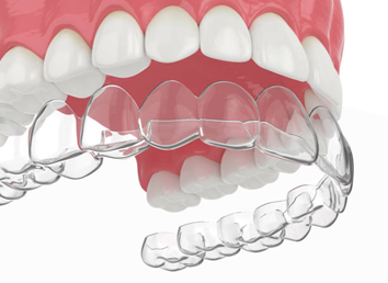 Aligners Cost in Seegehalli