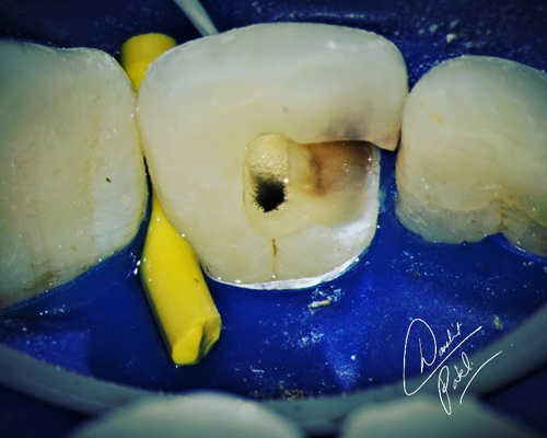microscopic-root-canal