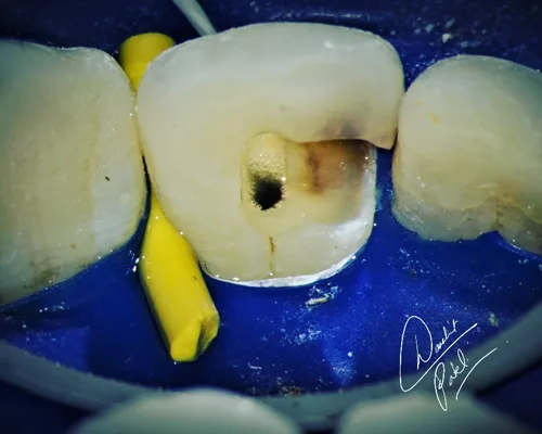 microscopic-root-canal