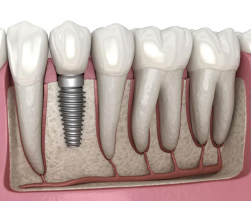 dental-implant