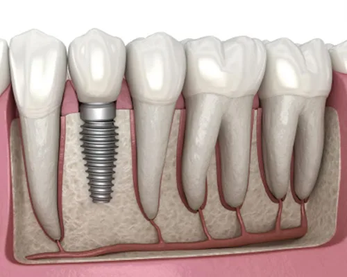 dental-implant