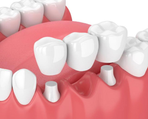 dental-bridge