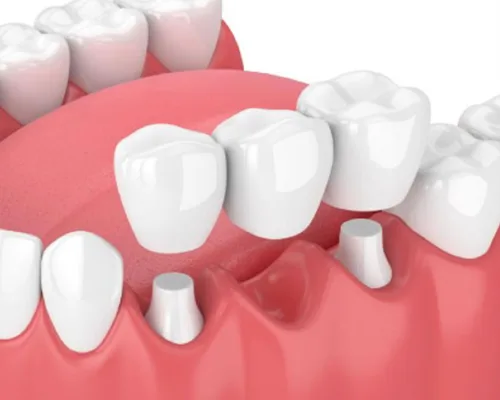 dental-bridge