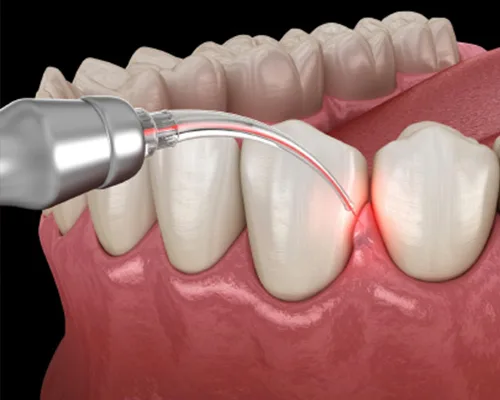 Gum Disease & Periodontal Treatment