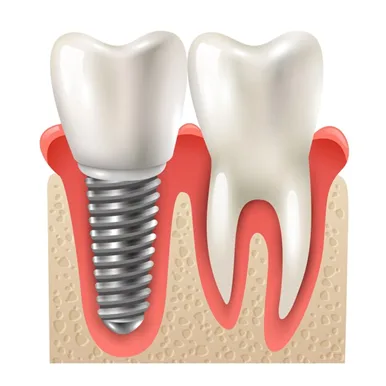 Single-Tooth-Implant