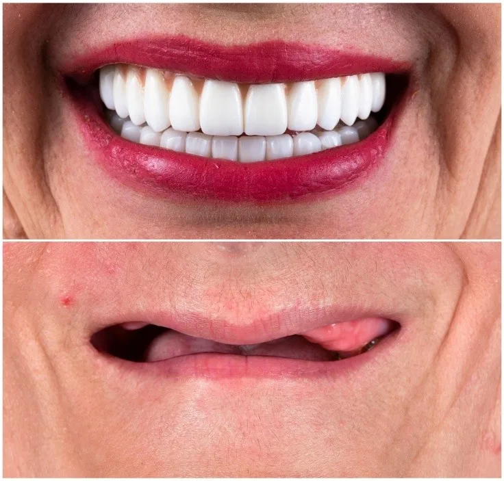 Full-Mouth-Rehabilitation