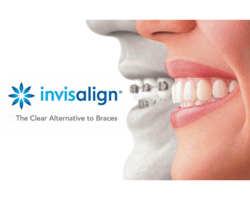 invisalign