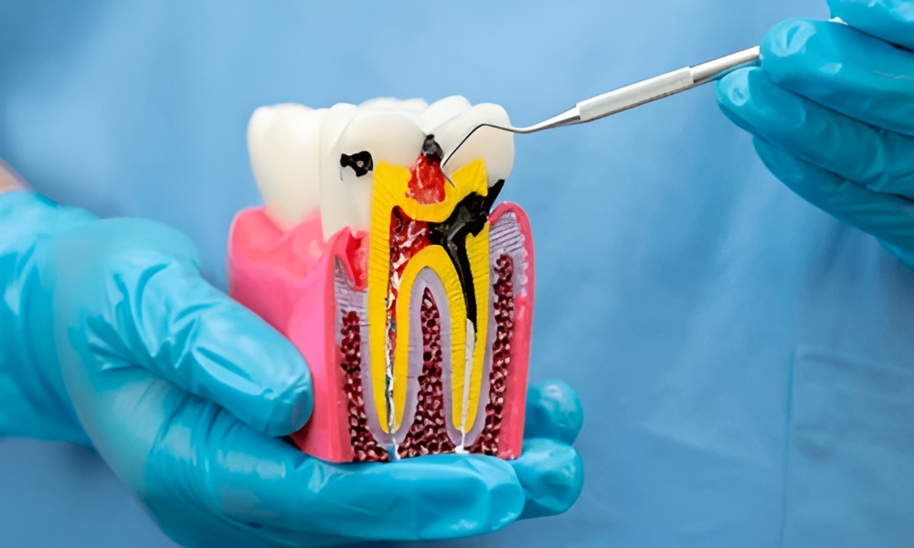 Root Canal Treatments