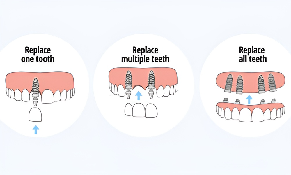 Root Canal Treatments