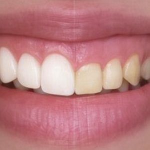 Close-up of a smiling mouth showing bright white front teeth and slightly yellowed side teeth.