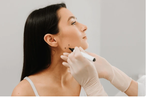 Side profile of a woman while a clinician in gloves marks her chin with a marker for a cosmetic procedure.