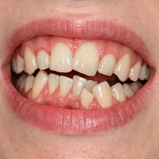 Close-up of a mouth showing crowded, misaligned teeth with gaps and an uneven bite.