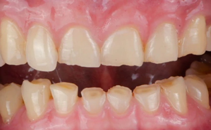 Close-up of upper and lower teeth showing misalignment and gaps, with visible pink gums.