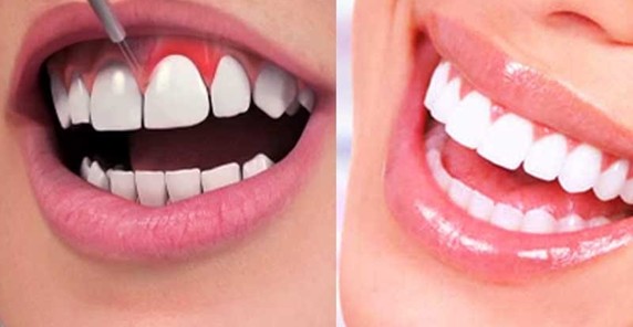 Left: close-up of teeth with whitening gel applied; right: bright white smile after whitening.