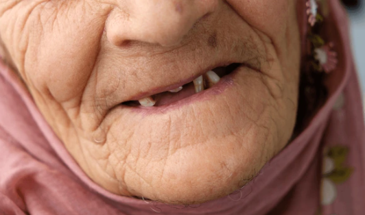Close-up of an elderly person's mouth showing missing teeth, with wrinkled lips and a pink headscarf.