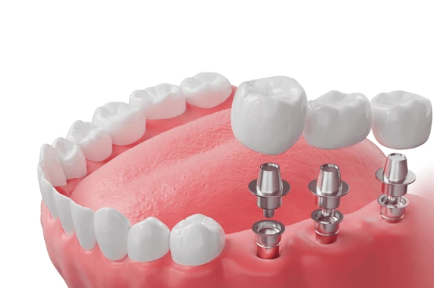 Upper jaw showing three dental implants with abutments in pink gum, preparing to support a row of dental crowns.