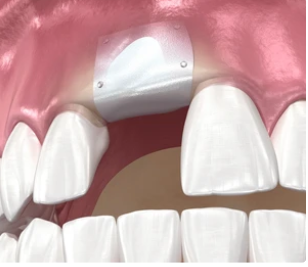 Close-up of upper front teeth showing a missing tooth and a white dental crown placed on the gum where the tooth would be.