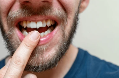 Close-up of a bearded man opening his mouth and pointing to a missing or gap between his front teeth with his finger, highlighting dental gap.
