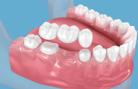 3D model of a human jaw showing teeth and gums, used to demonstrate dental restorations or prosthetics.