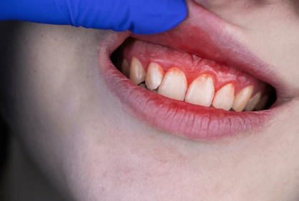 Close-up of a dental exam: a gloved finger lifts the upper lip to reveal red, inflamed gums and the front teeth.