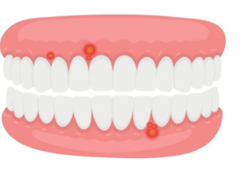 Cartoon illustration of a full denture set (upper and lower) in pink gums with a few red inflamed sores on the gum tissue.
