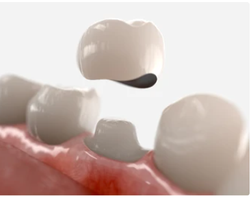 Close-up of a dental crown detached from a prepared tooth, hovering above pink gum tissue and neighboring teeth