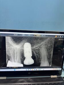 Dental X-ray on a laptop screen showing a dental implant next to a natural tooth and surrounding bone.