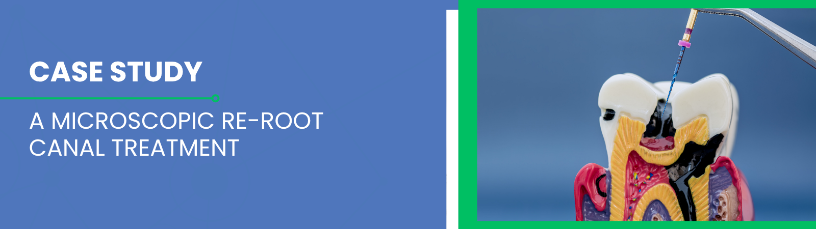 Case study cover on blue background; title about a microscopic re-root canal treatment with a dental model on the right.