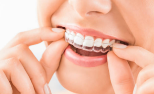 Close-up of a person fitting a clear dental aligner over their upper teeth.