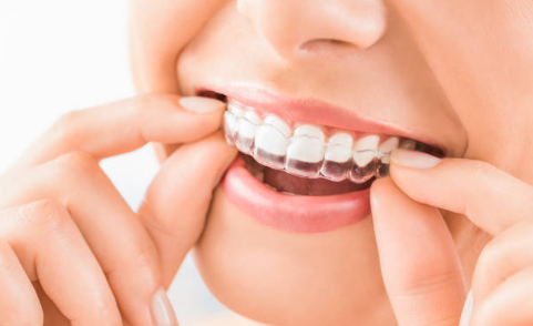 Close-up of a person fitting a clear dental aligner over their upper teeth.