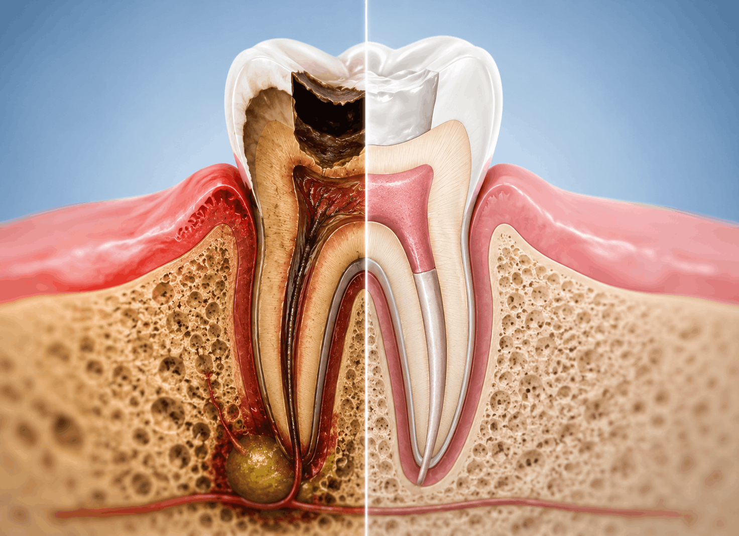 Root Canal Failure: Can It Be Retreated?