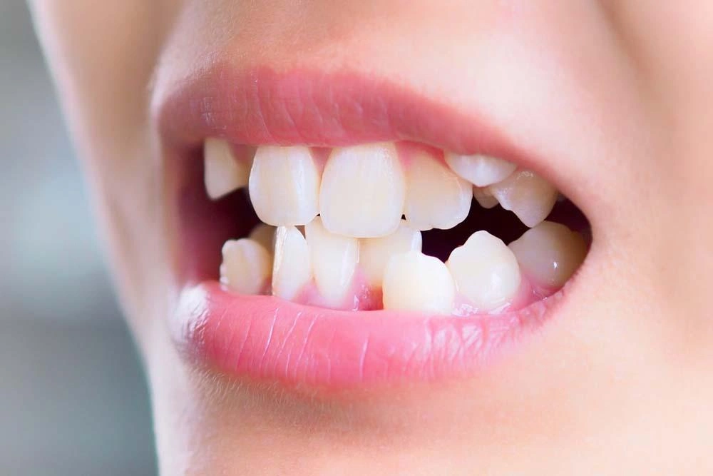 Close-up of a mouth showing crowded, misaligned front teeth in a child/young adult.