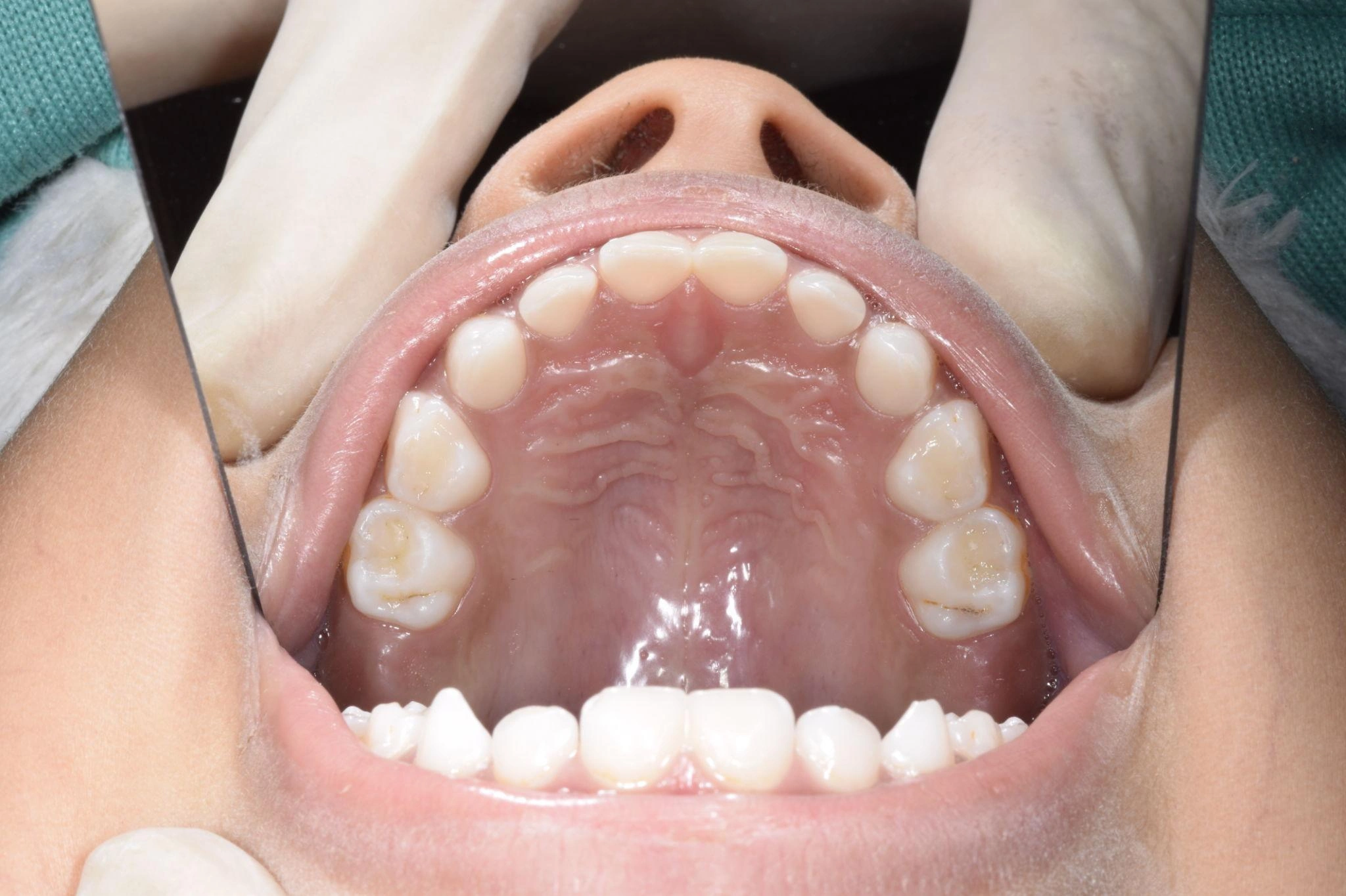 Close-up of the upper dental arch seen from below, with lips retracted.